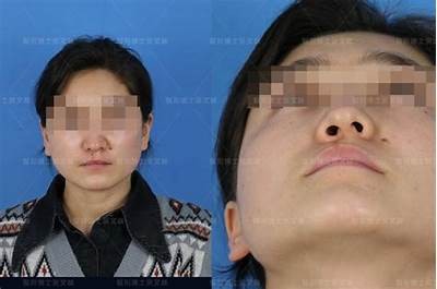 成人唇腭裂免费手术申请指南